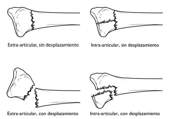 fractura extraarticular