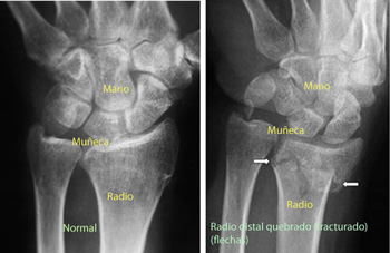 FracturaMuñecaRehabilitacion03