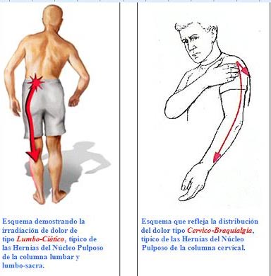 dolor-lumbar