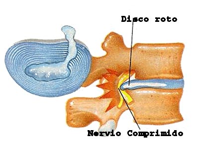 radiculopatia