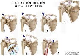 DislocacionHombro03