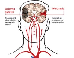 EnfermedadVascularCerebral_EVC_Rehabilitacion