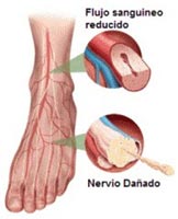 Nervios afectados por diabetes en pies