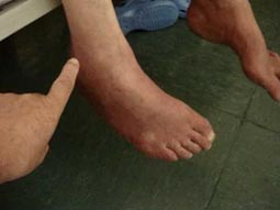 Sintomas de neuropatia diabetica
