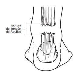 Rehabilitacion_TendonAquiles