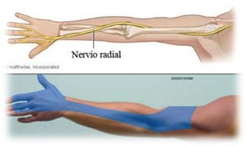 Nervio Radial 