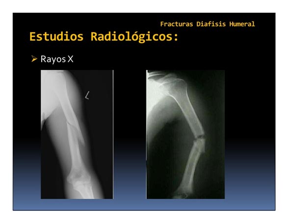 fisioterapia_humero01