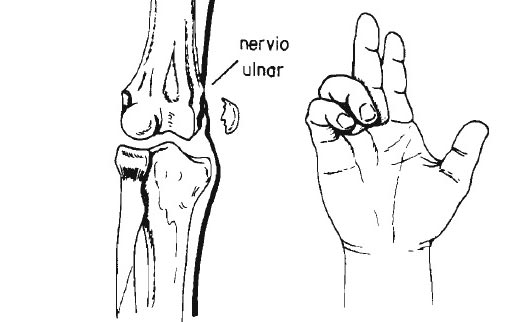 lesionnerviocubital02