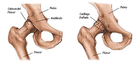 artroplastia_de_cadera01