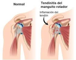 tendinitishombro01