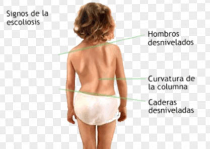 escoliosis-idiopatica-juvenil_02