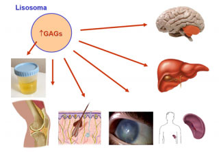 mucopolisacaridosis_02