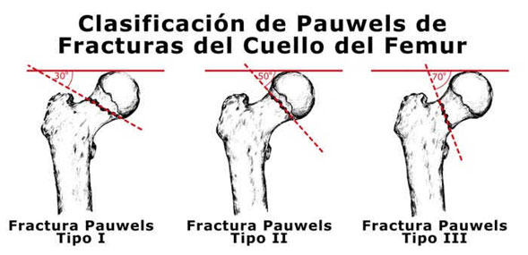 fracturafemuradultomayor03