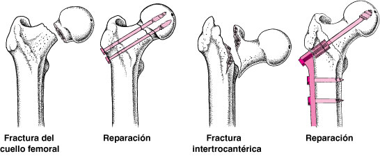 fracturafemuradultomayor04