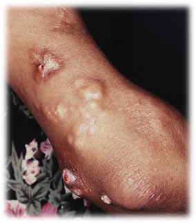 dermatomiositis03