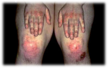 dermatomiositis04