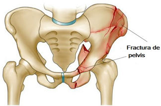 fracturapelvis01