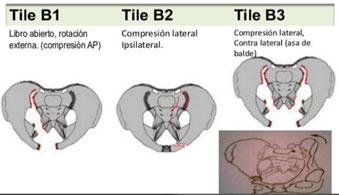 fracturapelvis02