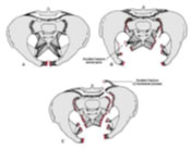 fracturapelvis04