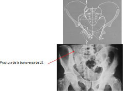 fracturapelvis07