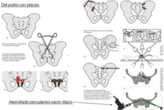 fracturapelvis09