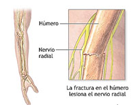 lesionnervioradialninios03